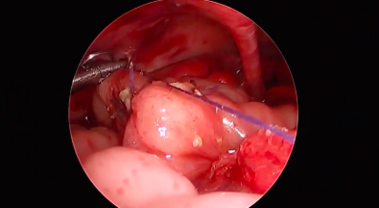 Intraoperatives Bild Duodenalatresie Das Bild zeigt ein intraoperatives Bild einer Duodenalatresie