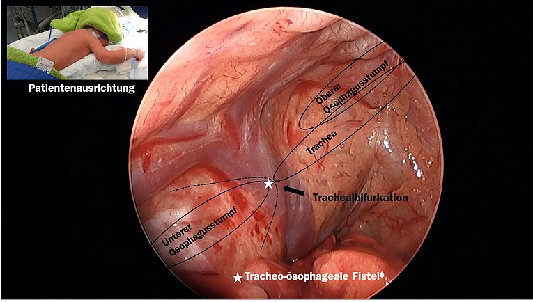 Video Ösophagusatresie